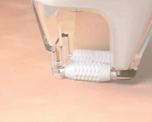 Pourquoi choisir le traitement LaseMD Ultra ?​